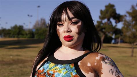 Nov 15, 2022 · Vitiligo on the vagina is sometimes called mucosal vitiligo (MV)—skin depigmentation in the mouth and/or genitals—or vulvar vitiligo (VV). White patches may appear on the vulva (the external genitalia), inside the vagina, or both. In children, vulvar vitiligo is sometimes referred to as “figure-of-eight disease” because of the typical ... 